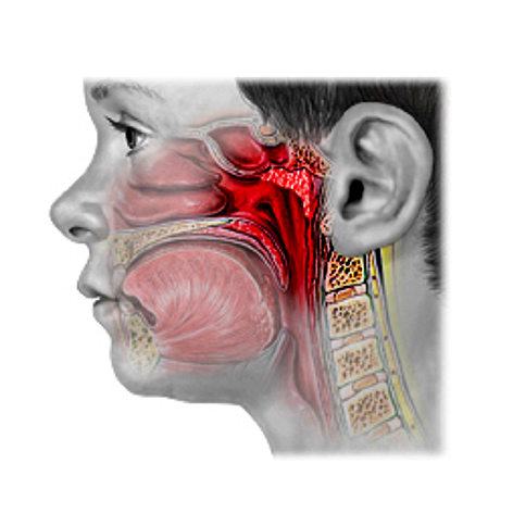 Adenoiditis tratamiento y cura