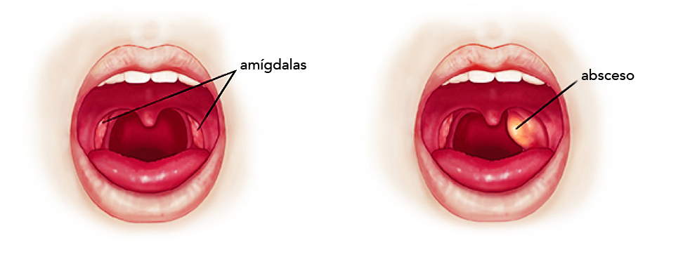 Drenaje de absceso periamigdalino