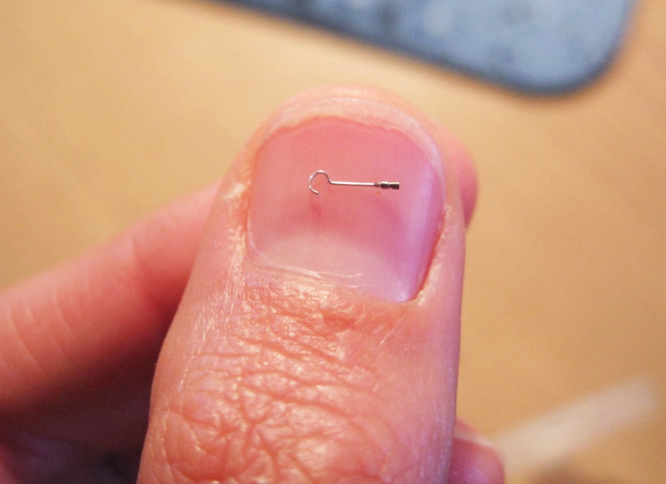 La estapedectomía - estapedotomía es una intervención quirúrgica orientada a corregir el defecto de audición ocasionado por la Otoesclerosis. Esta enfermedad es de origen hereditario y afecta al estribo, (el último de los huesecillos del oído medio) fijándolo e impidiendo que se transmita el sonido.