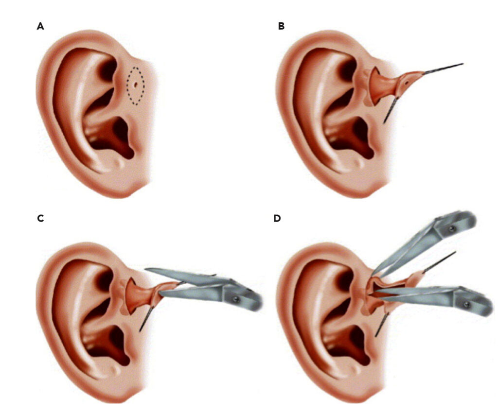 Cirugía de fístula preauricular