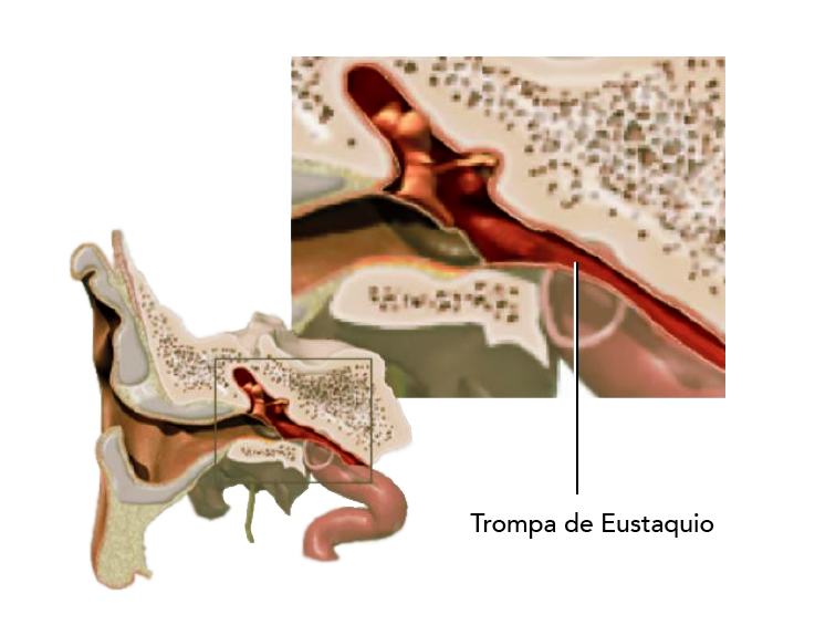 dilatación de la trompa de Eustaquio El procedimiento quirúrgico de dilatación de la trompa de Eustaquio consiste en introducir una sonda a través de la nariz, para provocar microrroturas de la trompa. De este modo, se consigue una dilatación permanente e inmediata de la trompa y la ventilación del oído medio