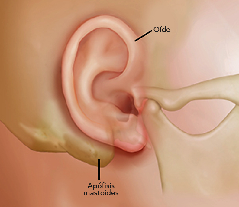 La mastoidectomía o cirugía de colesteatoma es una intervención quirúrgica que consiste en retirar una parte de un hueso localizado detrás del oído, llamado mastoides. Se realiza cuando existen indicios de algún daño al interior de su estructura o ante la presencia de una infección.