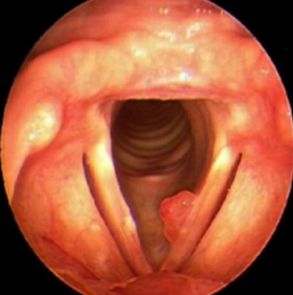 Microcirugía de laringe es un procedimiento en el cual se coloca un tubo rígido que va desde la boca hasta las cuerdas vocales que están en laringe. Este tubo permite al cirujano manipular las cuerdas vocales y patologías que estén en ellas, usando una visión con endoscopio, lo que posibilita el mejor de los accesos y visualización para el tratamiento de cualquier patología de las cuerdas vocales y laringe.