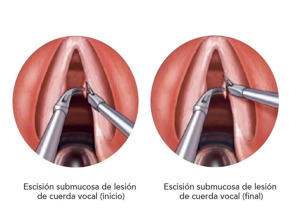 Microcirugía de laringe es un procedimiento en el cual se coloca un tubo rígido que va desde la boca hasta las cuerdas vocales que están en laringe. Este tubo permite al cirujano manipular las cuerdas vocales y patologías que estén en ellas, usando una visión con endoscopio, lo que posibilita el mejor de los accesos y visualización para el tratamiento de cualquier patología de las cuerdas vocales y laringe.