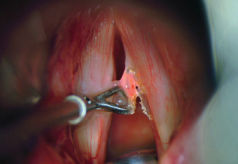 Microcirugía de laringe es un procedimiento en el cual se coloca un tubo rígido que va desde la boca hasta las cuerdas vocales que están en laringe. Este tubo permite al cirujano manipular las cuerdas vocales y patologías que estén en ellas, usando una visión con endoscopio, lo que posibilita el mejor de los accesos y visualización para el tratamiento de cualquier patología de las cuerdas vocales y laringe.