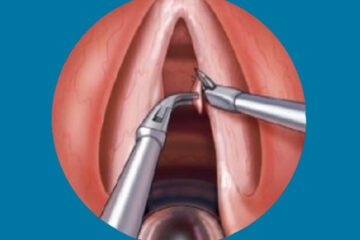 Microcirugía de laringe