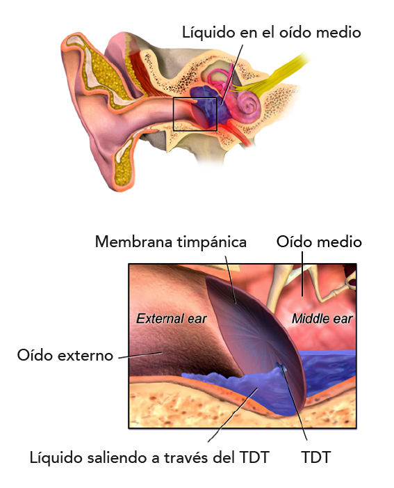 La miringotomía es el procedimiento quirúrgico, mediante el cual se realiza una pequeña incisión a la membrana timpánica, dándonos acceso directo a la caja timpánica permitiendo drenar el líquido contenido en la misma. 