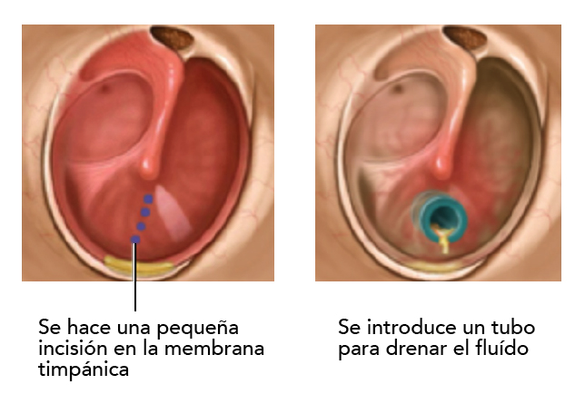La miringotomía es el procedimiento quirúrgico, mediante el cual se realiza una pequeña incisión a la membrana timpánica, dándonos acceso directo a la caja timpánica permitiendo drenar el líquido contenido en la misma. 