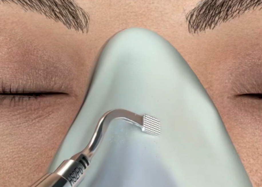 Rinoplastia ultrasónica Es la cirugía que se realiza para cambiar y mejorar la forma de la nariz, siempre preservando o creando su funcionamiento adecuado. La nariz es una de las partes del rostro que más puede definir a una persona, por lo que al momento de una rinoplastia, siempre debemos buscar que tenga una funcionalidad adecuada, naturalidad, combinando siempre los beneficios tanto funcionales como estéticos.