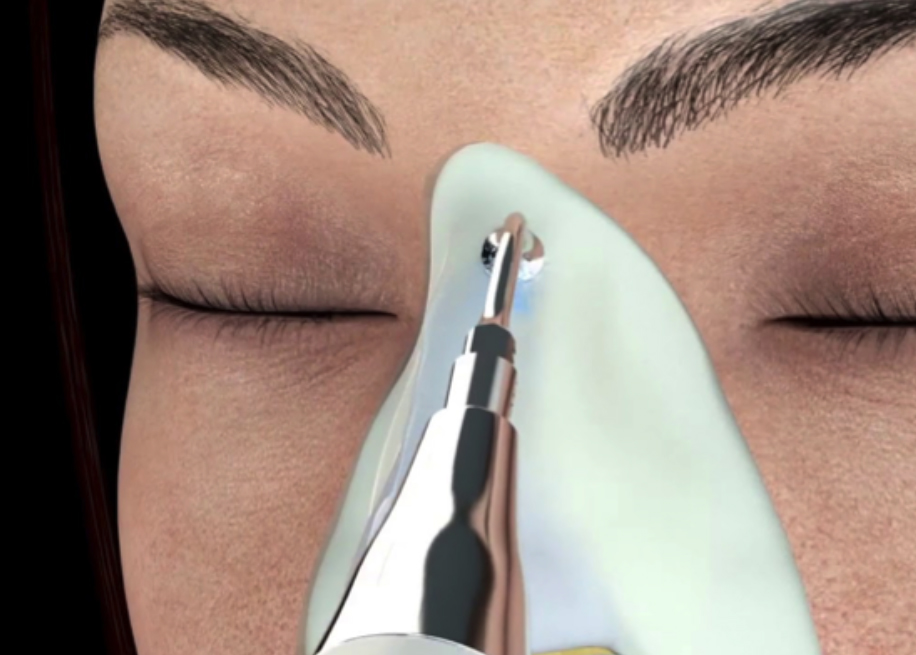 Rinoplastia ultrasónica Es la cirugía que se realiza para cambiar y mejorar la forma de la nariz, siempre preservando o creando su funcionamiento adecuado. La nariz es una de las partes del rostro que más puede definir a una persona, por lo que al momento de una rinoplastia, siempre debemos buscar que tenga una funcionalidad adecuada, naturalidad, combinando siempre los beneficios tanto funcionales como estéticos.