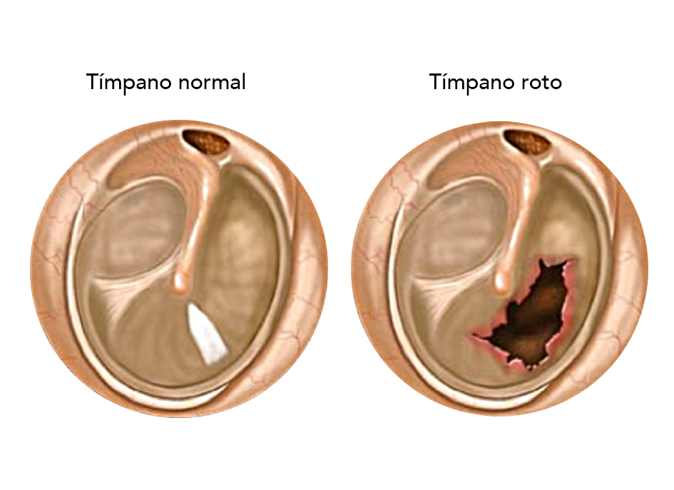 Si estás buscando una solución para problemas de tímpano, ¡has llegado al lugar correcto! En nuestro centro médico ofrecemos servicios de timpanoplastia para ayudar a nuestros pacientes a superar esta afección.