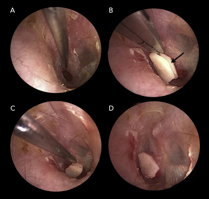 Si estás buscando una solución para problemas de tímpano, ¡has llegado al lugar correcto! En nuestro centro médico ofrecemos servicios de timpanoplastia para ayudar a nuestros pacientes a superar esta afección.