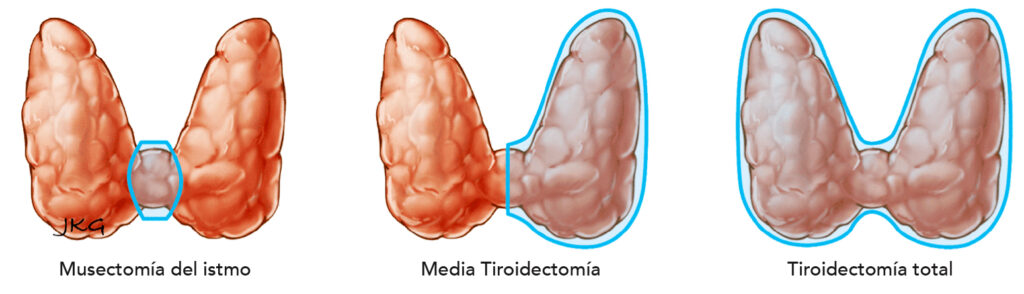 La tiroidectomía es la extirpación quirúrgica de la totalidad o parte de la glándula tiroides. La tiroides es una glándula con forma de mariposa que se encuentra en la base del cuello. Produce hormonas que controlan todos los aspectos de tu metabolismo, desde la frecuencia cardíaca hasta la rapidez con la que quemas calorías.