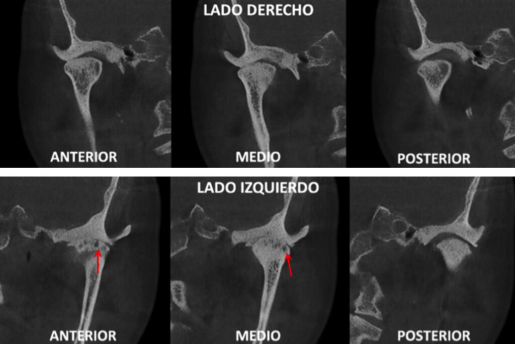 Tomografía de articulación temporomandibular, Las articulaciones temporomandibulares o ATM se encuentran entre el hueso temporal y la mandíbula. Éstas representan un papel fundamental en la masticación, deglución, fonación y expresividad facial.