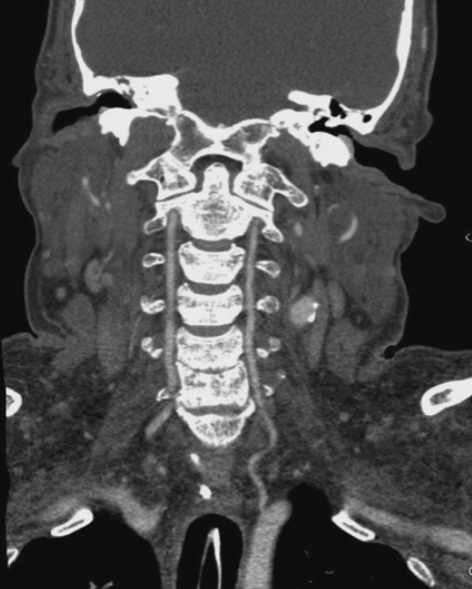 La tomografía computarizada de la columna cervical es una técnica radiológica para visualizar las vértebras y la médula espinal.
