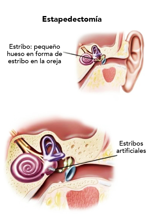 estapedectomía o cirugía de otoesclerosis