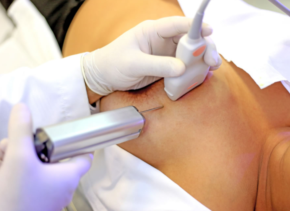 biopsia con aspiración de aguja fina o PAAF