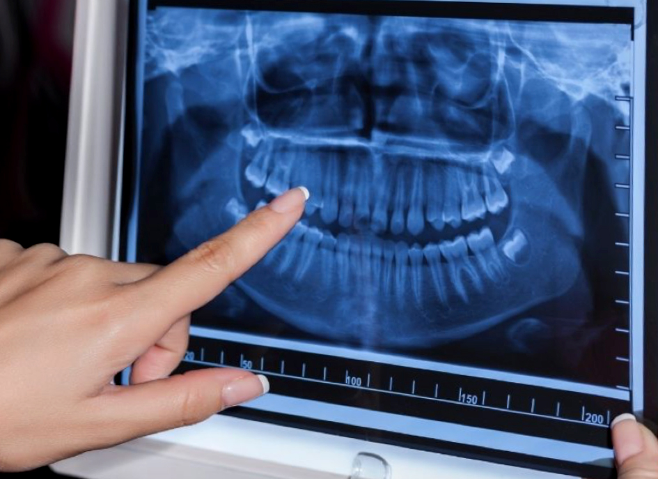 Una radiografía panorámica dental es un examen dental con rayos X bidimensionales (2-D) que captura imágenes de la boca entera en una sola toma, incluyendo los dientes, las mandíbulas inferior y superior y las estructuras y tejidos circundantes.