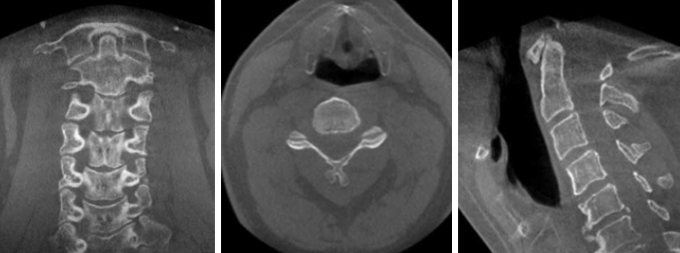 Tomografía de columna cervical