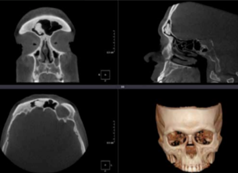 La tomografía de macizo facial es una prueba radiológica, que consiste en obtener imágenes del macizo facial (cara) de alta definición anatómica mediante el empleo de un equipo de TC (Tomografía Computarizada).