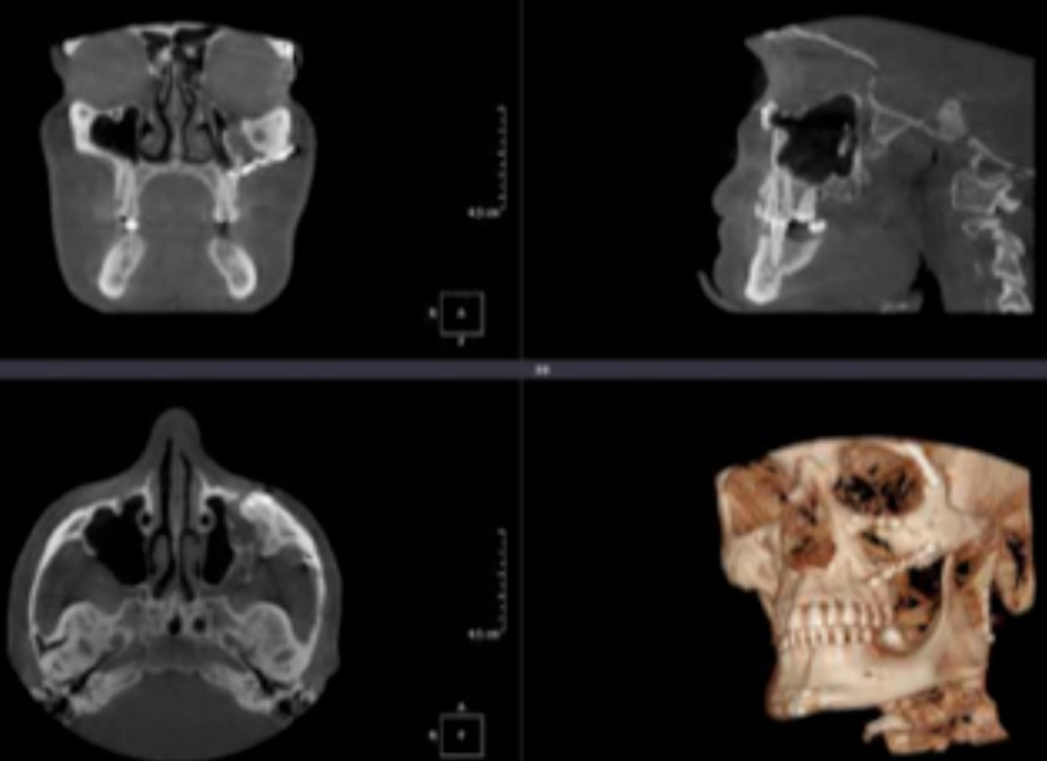 La tomografía de macizo facial es una prueba radiológica, que consiste en obtener imágenes del macizo facial (cara) de alta definición anatómica mediante el empleo de un equipo de TC (Tomografía Computarizada).