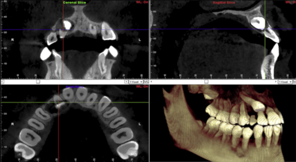 La tomografía dental utiliza rayos X para obtener imágenes en tres dimensiones de los dientes y los huesos maxilares superiores e inferiores del paciente.