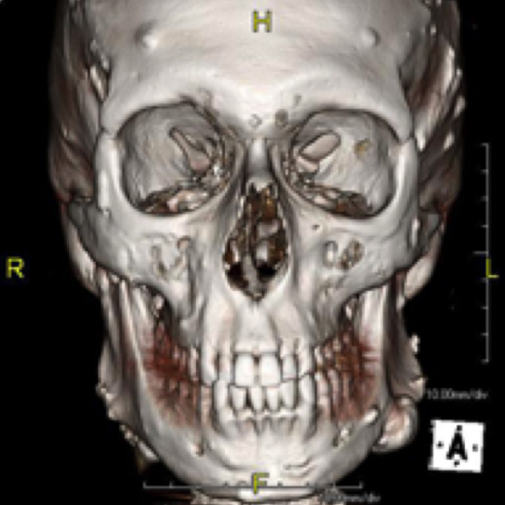 La tomografía de macizo facial es una prueba radiológica, que consiste en obtener imágenes del macizo facial (cara) de alta definición anatómica mediante el empleo de un equipo de TC (Tomografía Computarizada).
