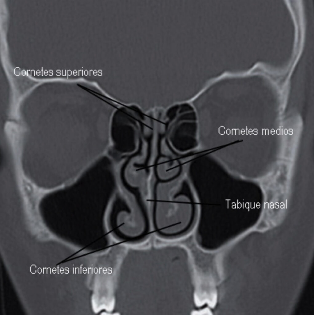 Turbinoplastia o cirugía de los cornetes